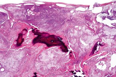 Fig. 4, Ancient schwannoma.