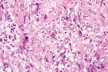 Fig. 5, Ancient schwannoma.