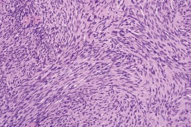 Fig. 1, Cellular schwannoma.