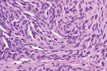 Fig. 3, Cellular schwannoma.