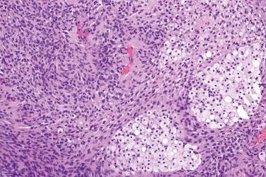 Fig. 4, Cellular schwannoma.