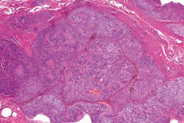 Fig. 1, Epithelioid schwannoma.