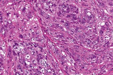 Fig. 4, Epithelioid schwannoma.