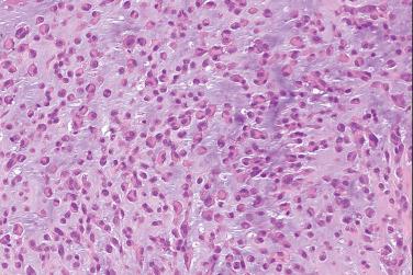 Fig. 6, Epithelioid schwannoma.