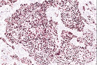 Fig. 9, Epithelioid schwannoma.