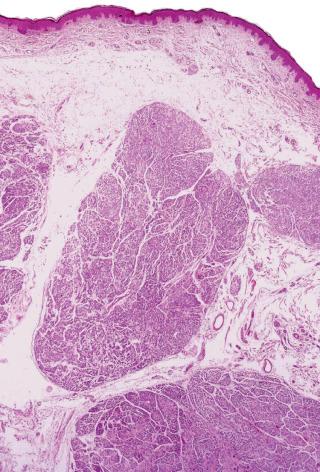 Fig. 1, Neuroblastoma-like schwannoma.