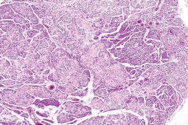 Fig. 2, Neuroblastoma-like schwannoma.