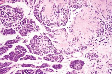 Fig. 3, Neuroblastoma-like schwannoma.