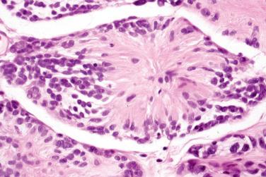 Fig. 4, Neuroblastoma-like schwannoma.