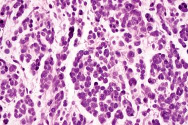 Fig. 5, Neuroblastoma-like schwannoma.