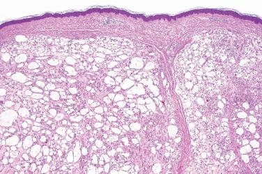 Fig. 1, Microcystic/reticular schwannoma.