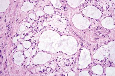 Fig. 2, Microcystic/reticular schwannoma.