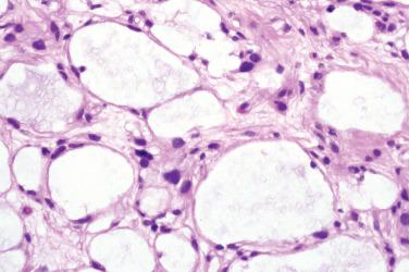 Fig. 4, Microcystic/reticular schwannoma.