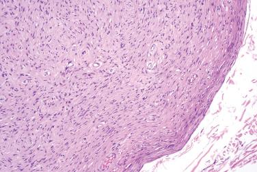 Fig. 2, Hybrid schwannoma/perineurioma.