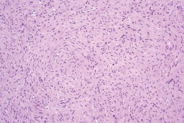 Fig. 3, Hybrid schwannoma/perineurioma.