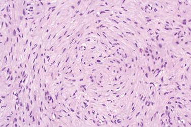 Fig. 4, Hybrid schwannoma/perineurioma.