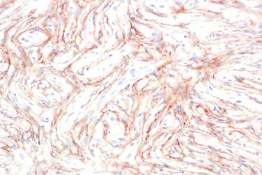 Fig. 5, Hybrid schwannoma/perineurioma.