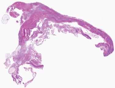 Fig. 1, Morton neuroma.