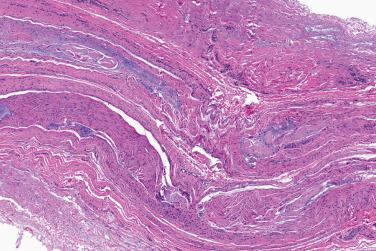 Fig. 2, Morton neuroma.