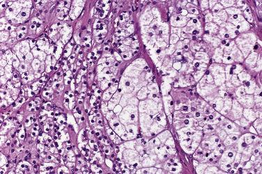 FIG. 19.11, Aldosterone-secreting cortical adenoma showing cells resembling those of the zona glomerulosa (left center), zona fasciculata (right half), and hybrid cells intermediate between the two. Cells are arranged in short cords and alveolar clusters.