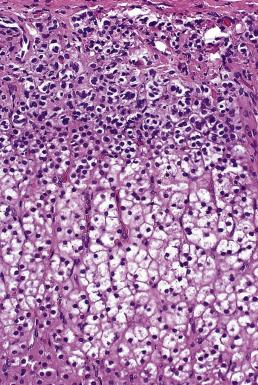 FIG. 19.12, Adrenal cortex attached to aldosterone-secreting adenoma shows hyperplasia of the zona glomerulosa, as evidenced by a continuous thickened zone beneath the capsule.