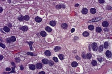 FIG. 19.13, Ipsilateral adrenal cortex from patient with aldosterone-secreting cortical adenoma has small eosinophilic, scroll-like inclusions within the cytoplasm of some cells of the zona glomerulosa. Inclusions range in size from 2 to 12 µm and are often similar in size to the nucleus of the cell.