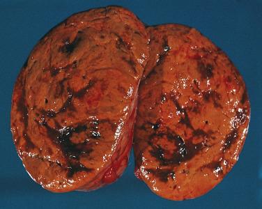 FIG. 19.3, Adrenal cortical adenoma on section is yellow-orange with irregular darker areas because of congestion and hemorrhage.