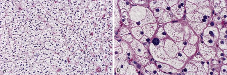 FIG. 19.4, (A) Adrenal cortical adenoma with Cushing syndrome is composed of alveolar clusters of lipid-rich cells resembling fasciculata type cells. Most nuclei are round and slightly vesicular with small dotlike nucleoli. (B) Adrenal cortical adenoma contains cells with abundant pale-staining cytoplasm that is finely vacuolated. Although cells of this type have been referred to as clear cells, the cytoplasmic lipid gives a finely vacuolated or vesicular quality to the cytoplasm. Most nuclei have a single small nucleolus.