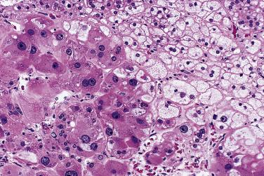 FIG. 19.6, Some tumor cells have compact, eosinophilic cytoplasm as a result of lipid depletion, whereas others have pale-staining, finely vacuolated or vesicular cytoplasm. A sparse amount of granular pigment in some cells is probably lipofuscin. Note that some cells have enlarged nuclei with prominent nucleoli.