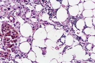 FIG. 19.7, Adrenal cortical adenoma showing a component of myelolipomatous metaplasia. Some tumor cells have conspicuous lipochrome pigment.