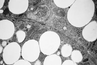 FIG. 19.8, Abundant lipid is present within tumor cells of this adrenal cortical adenoma from a patient with Cushing syndrome. Mitochondria are ovoid to elongate with prominent tubulovesicular cristae. Smooth endoplasmic reticulum was prominent in some fields, along with a small component of rough endoplasmic reticulum.