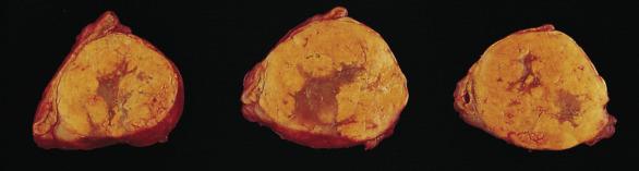 FIG. 19.9, Aldosterone-secreting adrenal cortical adenoma (aldosteronoma) is yellow-orange on section, with irregular slightly darker areas. Residual adrenal cortex is apparent along one edge of the tumor (upper left). 1a