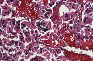 FIG. 28.11, Carotid body paraganglioma composed of oncocytic cells having abundant, finely granular cytoplasm that is deeply eosinophilic. Near the center of the field, tumor cells have interdigitating cytoplasmic processes with concentric arrangement.