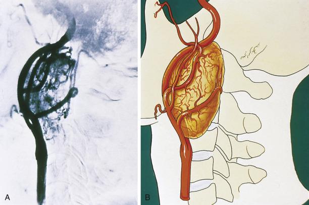 FIG. 28.12, (A, B) Vagal paraganglioma has no intrinsic involvement of the carotid bifurcation. The tumor causes anterior displacement of both carotid branches and extends up to the base of the skull. 1