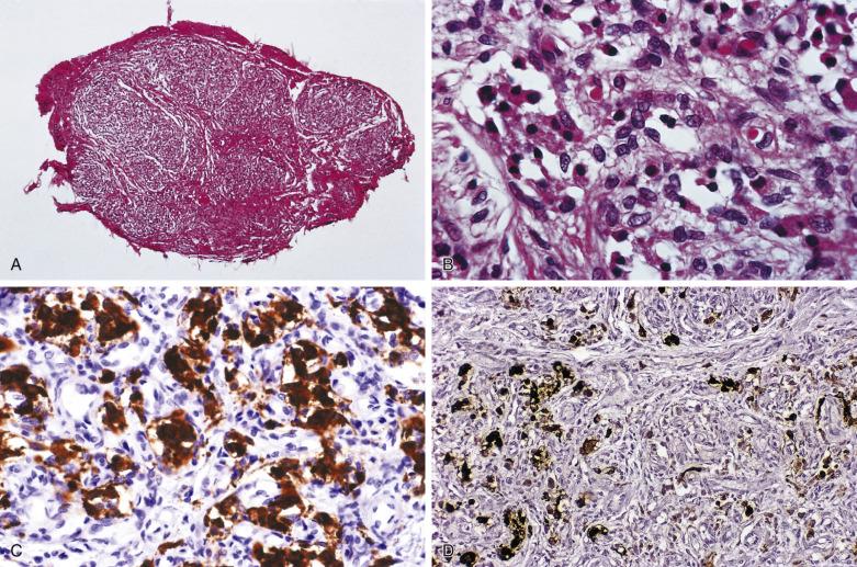 FIG. 28.3, (A) Cross section of a normal carotid body from a young child. Note the lobular architecture with intersecting bands of fibrovascular connective tissue. (B) Normal carotid body lobule. Chief cells are arranged in short cords and clusters (Zellballen) and have granular pink cytoplasm. Sustentacular cells have lentiform pale nuclei and are present at the periphery of clusters of chief cells. (C) Immunostain for synaptophysin (same immunoreaction for chromogranin A) in a normal carotid body shows distinct nests of chief cells. (D) Sustentacular cells in a normal carotid body show both nuclear and cytoplasmic staining for S-100 protein. Some cells probably represent Schwann cells because of rich innervation of the carotid body.