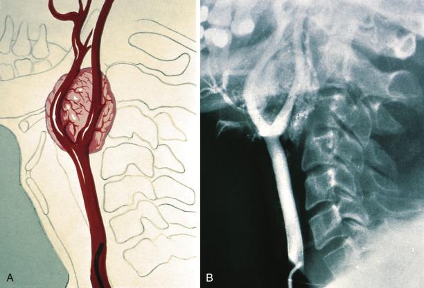 FIG. 28.4, (A, B) Carotid body paraganglioma causes widening of the carotid bifurcation on selective angiography and has a distinct tumor blush.