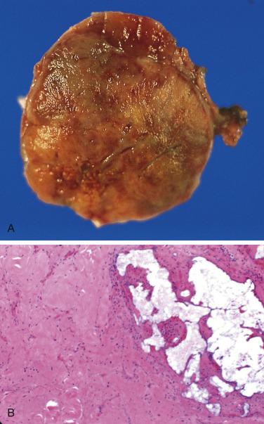 FIG. 28.5, (A) Carotid body paraganglioma resected from a 40-year-old woman. The patient had a similar tumor resected from the opposite side and gave a positive family history of carotid body paragangliomas. The tumor was embolized before surgery and had areas of ischemic necrosis. (B) Tumor showed confluent areas of ischemic necrosis after selective embolization; embolic material is present in vessel on right side.