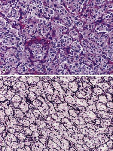 FIG. 28.6, Carotid body paraganglioma. (A) Note the organoid arrangement of tumor cells with pink granular cytoplasm. (B) The alveolar nesting pattern is accentuated in this stain for reticulin.