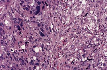 FIG. 28.7, Carotid body paraganglioma shows enlarged collections of cells on the left with an area of central degeneration. Note random distribution of clear vacuoles, which may represent a processing or fixation artifact. The patient was alive and well 8 years later.