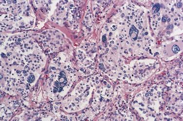 FIG. 28.8, Area of carotid body paraganglioma showing nuclear pleomorphism and hyperchromasia along with a few nuclear pseudoinclusions.