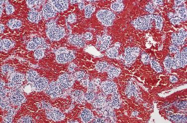 FIG. 28.9, Marked hemorrhage and congestion in a carotid body paraganglioma with separation of discrete nests of tumor cells. Other areas had more typical histology.