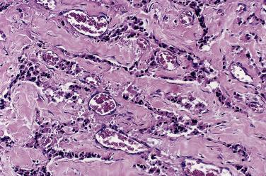 FIG. 28.10, Vagal paraganglioma. Marked sclerosis is present with compression of tumor cells in thin cords; other areas showed abundant hemosiderin deposition.