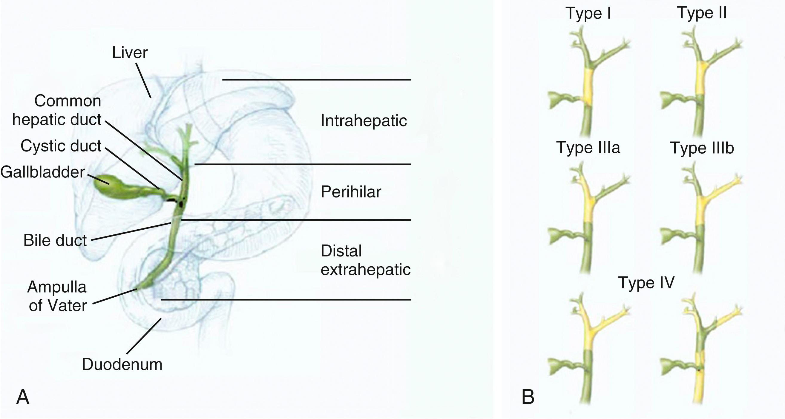 Fig. 69.1, Classification of cholangiocarcinoma. A , Anatomic classification of intrahepatic, perihilar, and distal cholangiocarcinoma. B , Bismuth-Corlette classification of hilar cholangiocarcinoma as types I to IV. Tumor is depicted in yellow and normal bile ducts in green.