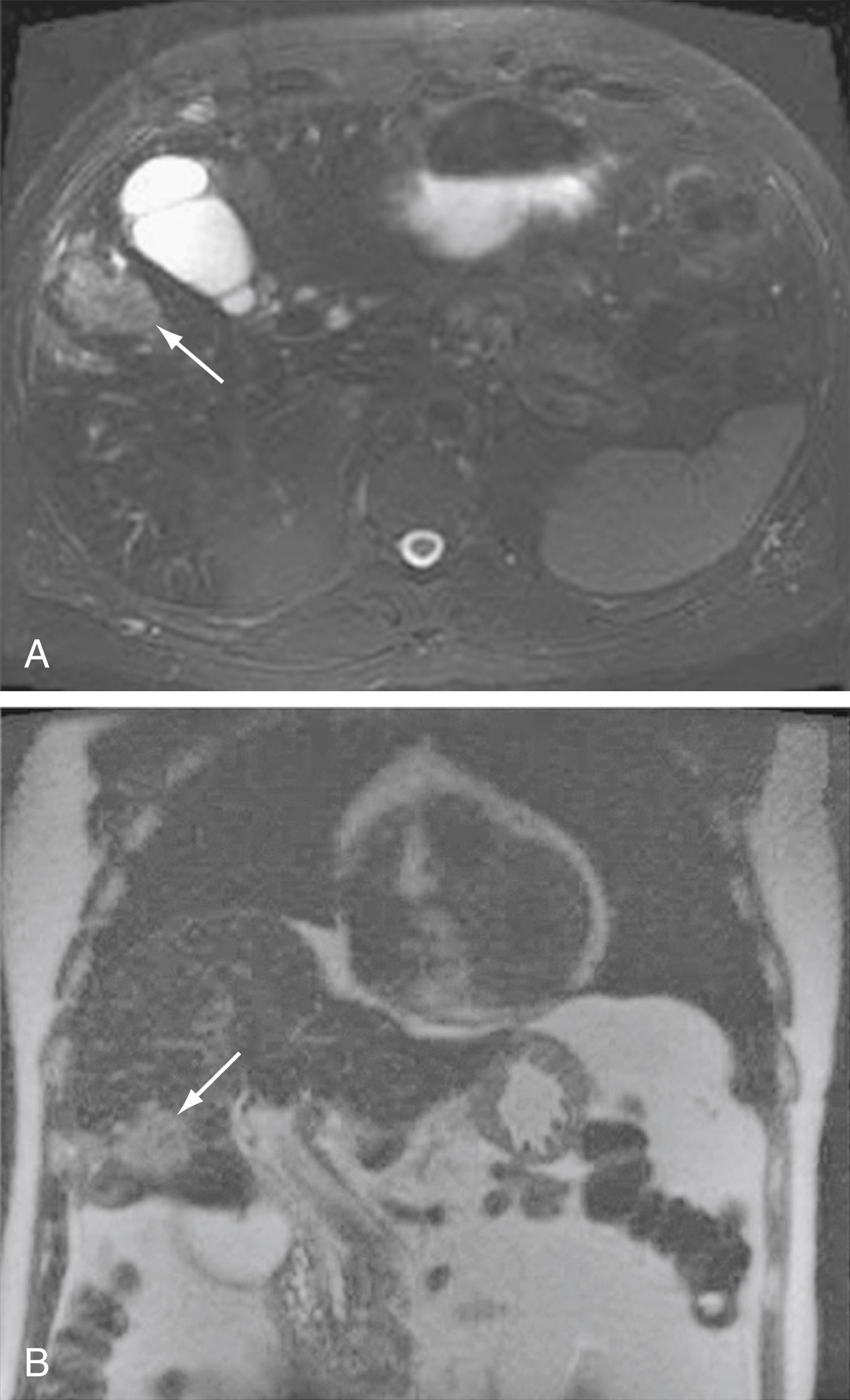 Fig. 69.4, Imaging of intrahepatic cholangiocarcinoma. A gadolinium-enhanced MRI with ferumoxide in a patient with an intrahepatic cholangiocarcinoma is depicted. The arrows point to the tumor in the T2-weighted images. A , Axial view. B , coronal view.