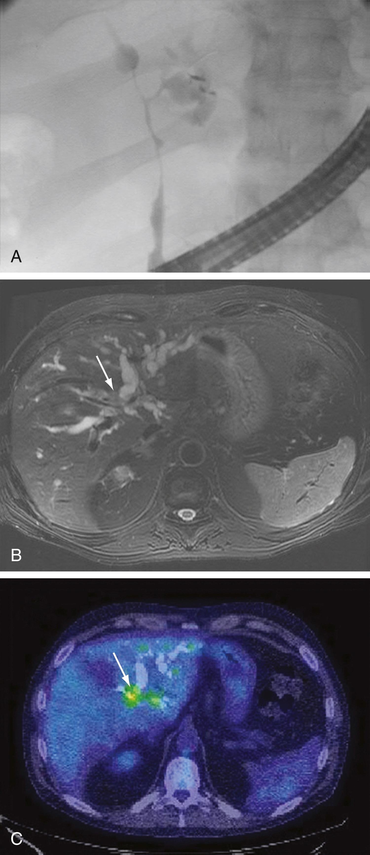 Fig. 69.5, Imaging of perihilar cholangiocarcinoma. A , Film from an ERCP in a patient with perihilar cholangiocarcinoma demonstrating dominant strictures of the biliary tract consistent with Bismuth-Corlette type IV. B , Gadolinium-enhanced MRI with ferumoxide in the same patient. The arrow points to the biliary tumor seen on a T2-weighted image. C , PET/CT scan of the same patient. The biliary tumor is seen as an enhancing region ( arrow ).