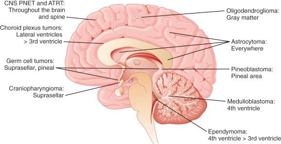 Figure 57-11, Common distributions of different pediatric central nervous system (CNS) tumor histologies. ATRT, Atypical teratoid/rhabdoid tumor; CNS PNET, primitive neuroectodermal tumor.