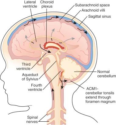 Figure 57-12, Normal flow of cerebrospinal fluid. Blue arrows show compression of cortex as a result of obstructive hydrocephalus. ACM1, Arnold-Chiari Malformation Type 1.