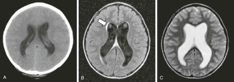 Figure 57-13, Hydrocephalus. A, An axial computed tomography noncontrast scan demonstrating significant enlargement caused by obstructive hydrocephalus. B, An axial fluid-attenuated inversion recovery image demonstrates enlarged ventricles and transependymal flow (arrow) , suggestive of raised intracranial pressure. C, An axial T2-weighted magnetic resonance image demonstrating enlarged ventricles.