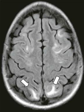 Figure 57-14, An axial fluid-attenuated inversion recovery image in a patient after radiation therapy with new-onset seizure and hypertension with bilateral hyperintense signal in the occipital lobes (arrows) . Also note increased signal to a lesser extent in the frontal lobe.