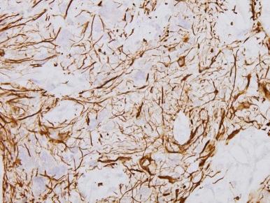 Figure 57-15, Glial acidic fibrillary protein staining of astrocytic cells in a child with glioblastoma multiforme (×400).